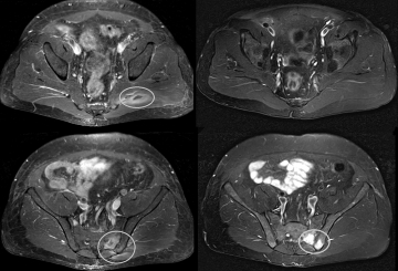 Fibromialgia y fatiga crónica causada por sensibilidad al gluten no celíaca